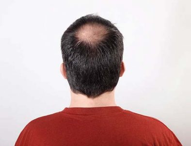 PERTE DE CHEVEUX hair loss