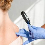 acne treatments laval