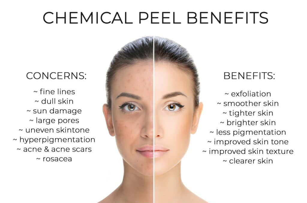 Skin Peel Treatment Laval - chemical peels benefits sun spots treatment laval acne treatments laval_skin texture treatments laval_scar treatment laval