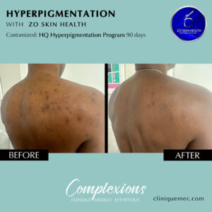 BEFORE-AFTER-ZO-hyperpigmentation-program-2-laval-clinique-complexions