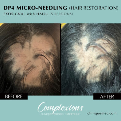 BEFORE-AFTER-microneedling-dp4-hair-restoration-laval-clinique-complexions