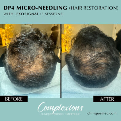 BEFORE-AFTER-microneedling-hair-restoration-exosignal-2-sessions-laval-clinique-complexions