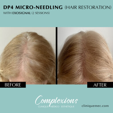 BEFORE-AFTER-microneedling-hair-restoration-female-laval-clinique-complexions