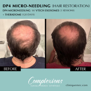 BEFORE-AFTER-microneedling-hair-restoration-laval-clinique-complexions