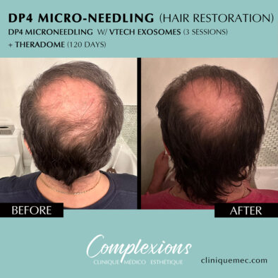 BEFORE-AFTER-microneedling-hair-restoration-laval-clinique-complexions