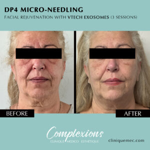 Before and After Microneedling – Laval Results |  Avant et Après Microneedling – Résultats Visibles à Laval