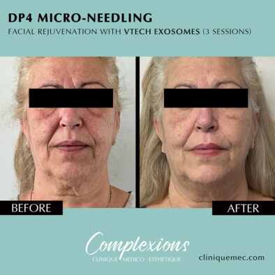 Before and After Microneedling – Laval Results | Avant et Après Microneedling – Résultats Visibles à Laval