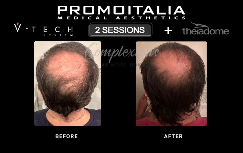 Exosome Teatment Laval Before and After with V-Tech-Promoitalia & Theradome by Clinique Médico Esthétique Complexions