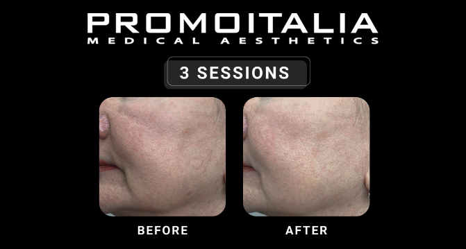 Exosome Treatment Laval - Before & After Promoitalia
