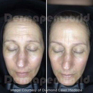 Woman Undergoing Collagen Induction Therapy in Laval | Femme Recevant un Traitement d’Induction de Collagène à Laval