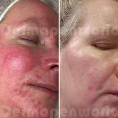 Laval Skincare Professional Performing Microneedling | Spécialiste en Soins de la Peau Effectuant un Microneedling à Laval