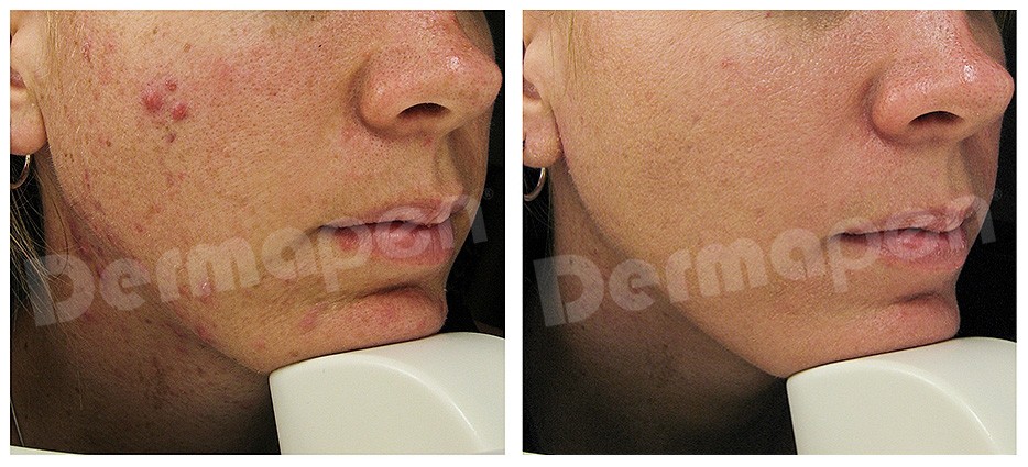 Microneedling treatment for acne scars Laval / Traitement Microneedling pour Cicatrices d'Acné à Laval