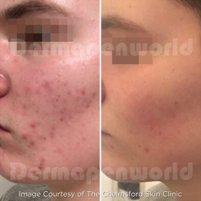 RF Microneedling Device in Laval Clinic | Appareil de Microneedling RF Utilisé en Clinique à Laval