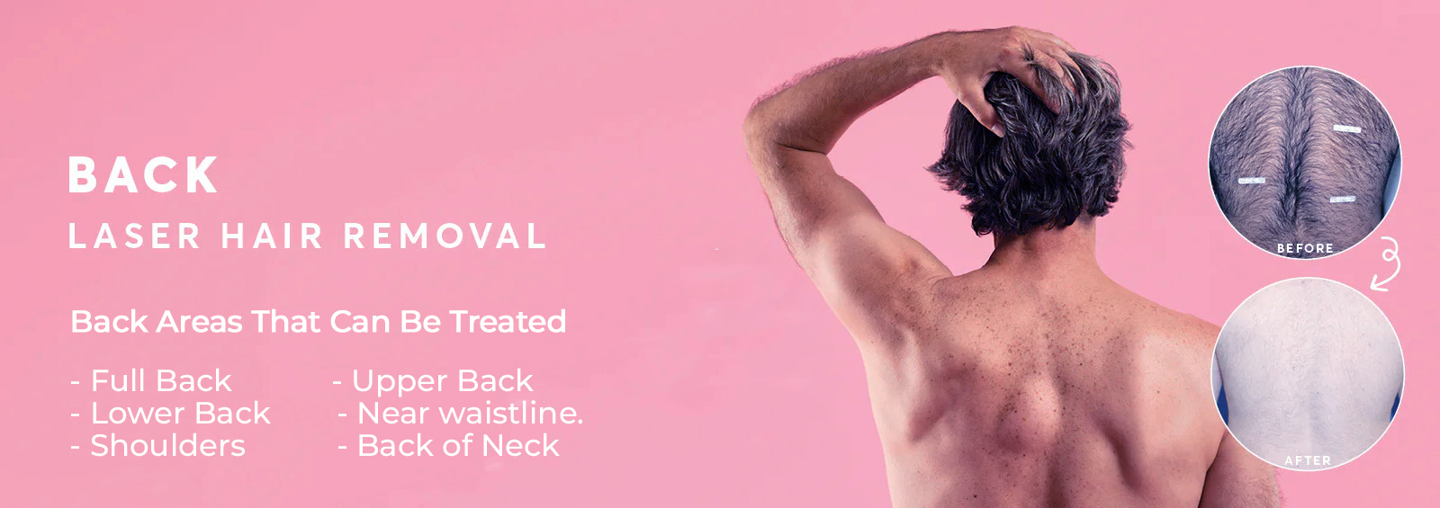 Laser hair removal for men’s back at aesthetic clinic in Laval