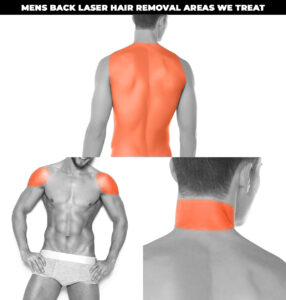 Full Back, Shoulders, Back of Neck, Laser Hair Removal for Men at Clinique Médico Esthétique Complexions