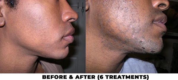 Laser Hair Removal Before and After 6 treatments