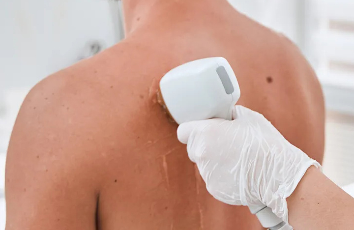 Laser Hair Removal Back