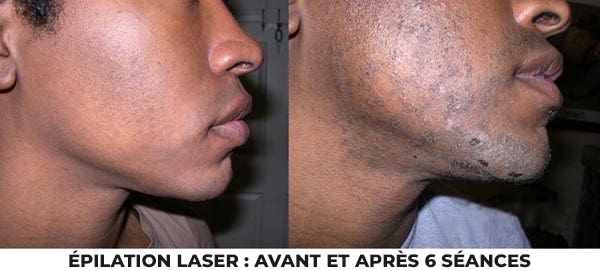 Épilation laser : avant et après 6 séances