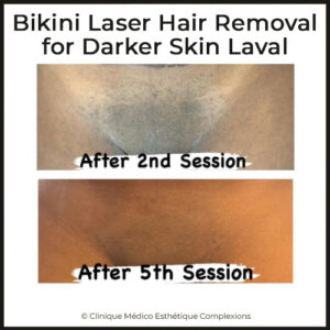 bikini laser hair removal for darker skin tones in laval