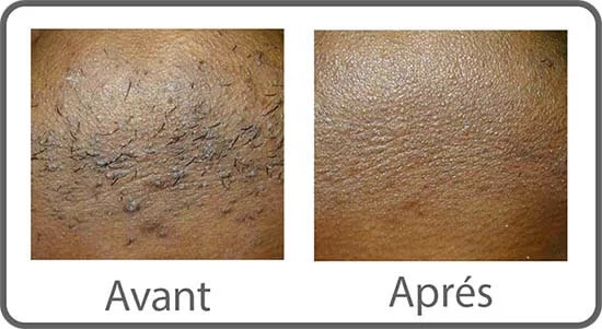 Laser hair removal results for Fitzpatrick IV-VI skin tones