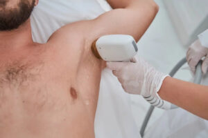 Mens Laser Hair Removal