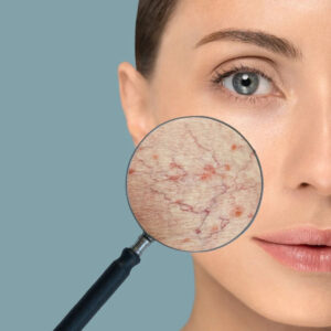 Traitement rosacée Laval par Vanessa I. à la Clinique MEC.